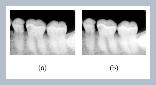 Analysis of Image Enhancement Techniques for Dental Caries Detection Using Texture Analysis and Support Vector Machine