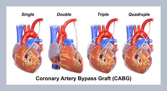 Cost analysis of coronary artery bypass grafting surgery under single-payer reimbursement in Taiwan