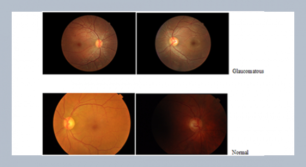 Deployment of CNN on colour fundus images for the automatic detection of glaucoma